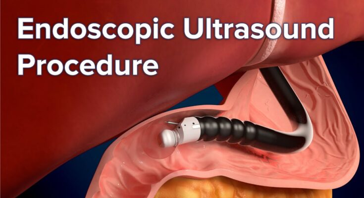 Endoscopy Ultrasound