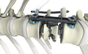 Spine Devices