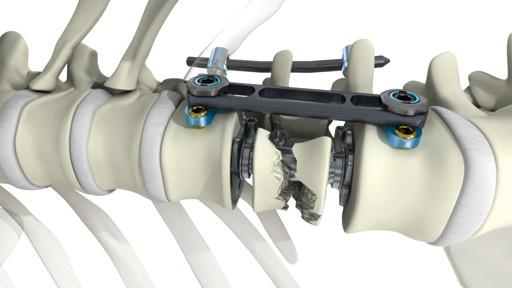 Spine Devices