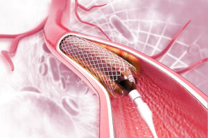 Biliary Stents Market